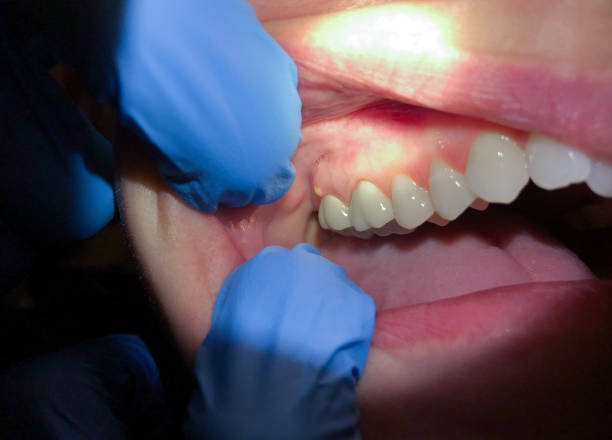Best Emergency Denture Repair in West Concord, MA